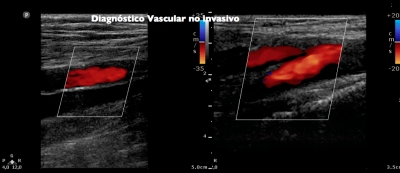 Diagnóstico Vascular no invasivo