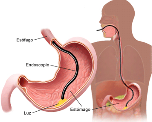 ¿Para qué sirve y cómo funciona una endoscopia?