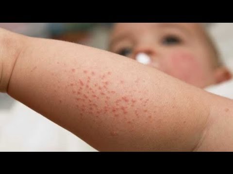 Cómo detectar alergias en niños de 0 a 36 meses