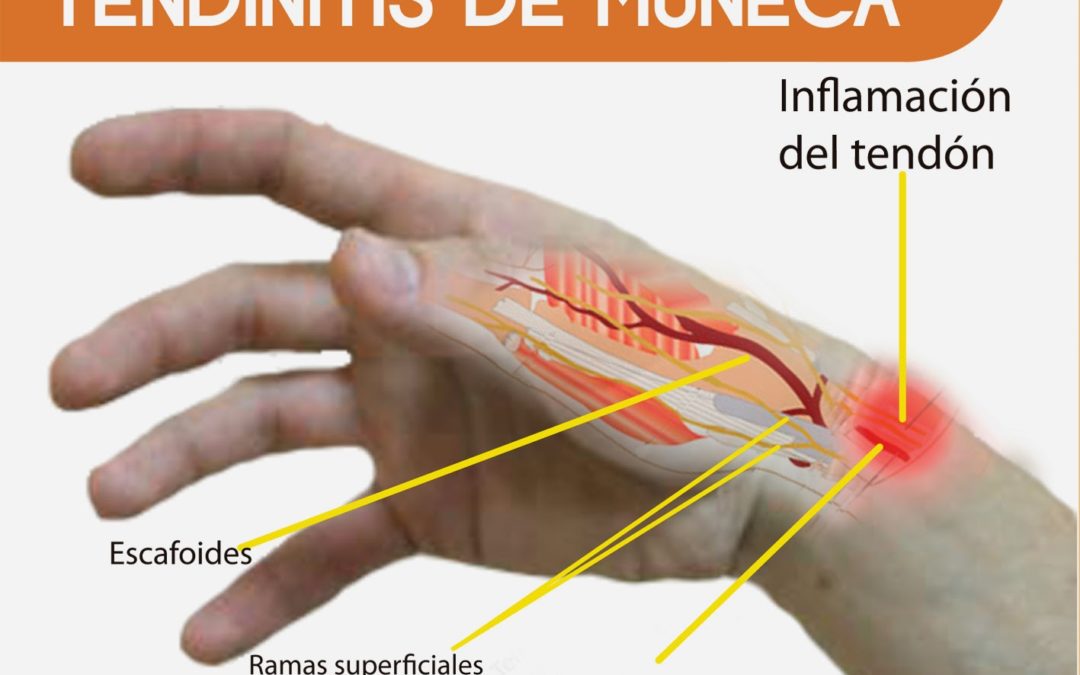 Tendinitis