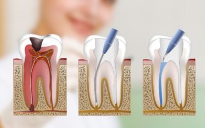 ¿Para qué sirve una endodoncia?