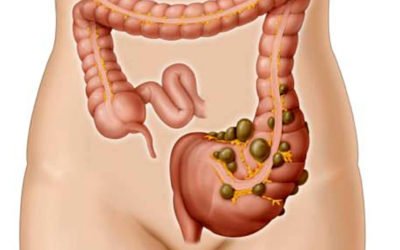 ¿Qué es la diverticulitis?